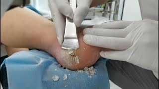 Remove Heel Fissure slowly amp carefully Cracked heel treatment amp Callus removal Dead skin removal [upl. by Yendis135]