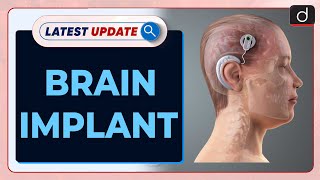 Brain Implant  Epilepsy  Latest Update  Drishti IAS English [upl. by Calida]