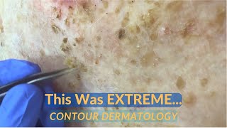 SEVERE Debridement of Seborrheic Dermatitis Scale  CONTOUR DERMATOLOGY [upl. by Akeinahs]