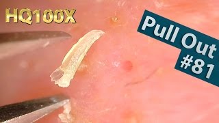 81 Pull Out Blackheads Close up 100X  Blackheads Removal  ピンセットで角栓を抜く [upl. by Calista]