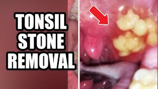 Tonsil Stones amp Removal At Home Compilation  Most Popular [upl. by Lambart]