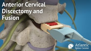 Anterior Cervical Discectomy and Fusion [upl. by Velda]