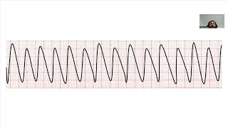 Ventricular Tachycardia [upl. by Regor]