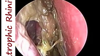 Atrophic Rhinitis Ozaena  Operated Youngs on Left amp Modified Youngs operation on Right [upl. by Obel869]