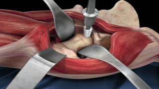 Direct Anterior Approach Hip Replacement [upl. by Niarda]