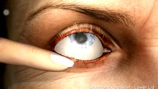 Blepharitis [upl. by Whelan]