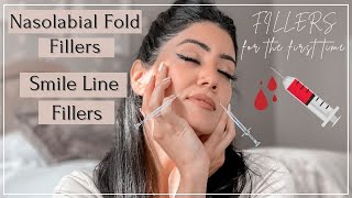 Nasolabial Fold Fillers  Laugh amp Smile Line Filler and PreventionBefore and After  BY SARV [upl. by Arretahs37]