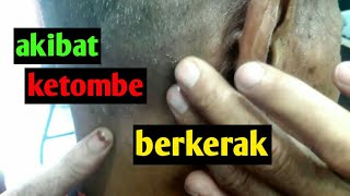 AKIBAT KETOMBE BERKERAK tak TAHAN AHIRNYA DI CUKUR [upl. by Elmo]