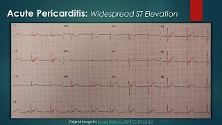 Acute Pericarditis ECG [upl. by Ruthy193]