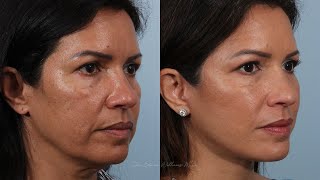 Day by Day Deep Plane Facelift Surgery Recovery [upl. by Aelak110]