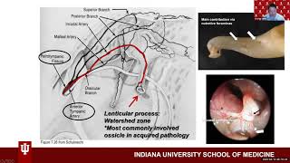 Ossicular Reconstruction  Dr Charles Yates [upl. by Materse]