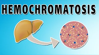 Hemochromatosis [upl. by Ahsel47]