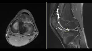 LMAH longitudinal tear [upl. by Zora]