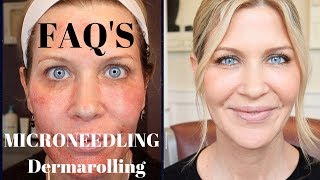 Microneedling  Dermarolling QampA  Before During and After Pics [upl. by Eatnoj]