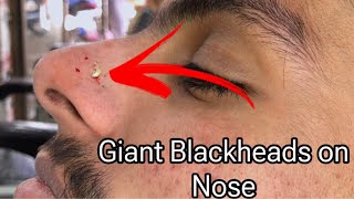 Blackheads on Nose  Giant Blackheads on Nose ​⁠ ​Popping Blackheads [upl. by Euqenimod814]