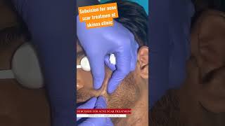 Subcision for acne scar treatment at skinaa clinic subcision subcisionforacnescar shortyoutube [upl. by Lasser]