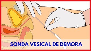 Sonda Vesical de Demora e os Cuidados de Enfermagem [upl. by Kenny]