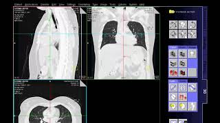 HRCT Scan Chest Techniq amp Filming [upl. by Iznyl]