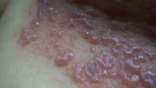 Herpes Zoster Parte 2 [upl. by Post]