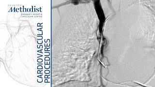 Central Venous Occlusion in Presence of a Defibrillator—Venographic Evaluation Alan B Lumsden MD [upl. by Negrom]