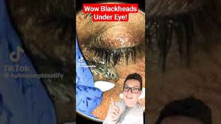 Crazy BLACKHEAD REMOVAL UNDER EYE  How Did This Happen shorts [upl. by Anglim641]