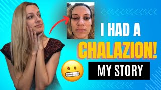 CHALAZION Symptoms Treatment Risk Factors Recovery My Story [upl. by Weatherby]