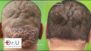 How to Get Rid of Bumps on Head  AKN Surgical Removal [upl. by Aihset779]