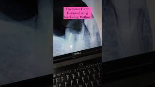 Tooth get fractured Removal done using Sectioning Method youtubeshorts viralvideo [upl. by Eizzo]