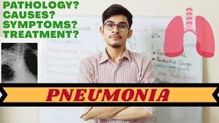 Pneumonia  Types Causes Symptoms and Diagnosis  UrduHindi [upl. by Enimzzaj523]