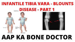 INFANTILE TIBIA VARA OR BLOUNTS DISEASE  PART 1  EPISODE 32 [upl. by Aerdnahs888]