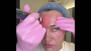 Microneedling Technique  Forehead [upl. by Swisher]