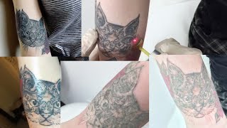 Laser Tattoo Removal Journey  BEFORE amp AFTERS [upl. by Iror]