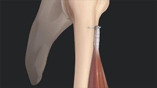 Biceps Tenotomy vs Tenodesis Literature Review and Rationale for Tenodesis [upl. by Yeltneb]