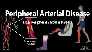 Peripheral artery disease Pathophysiology Causes Symptoms Diagnosis and Treatments Animation [upl. by David]