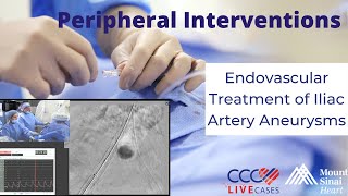 Endovascular Treatment of Iliac Artery Aneurysms  January 23 2019 [upl. by Ylurt658]