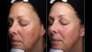 BBLMoxi Laser treatment at Woodford Medical  real patient review [upl. by Ellerehs]