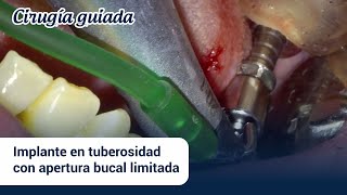 Cirugíaguiada Implante en tuberosidad con apertura bucal limitada [upl. by Anilak900]