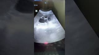 Severe Hydronephrosis with Renal Calculi ultrasound shortvideo shorts [upl. by Tiebout]