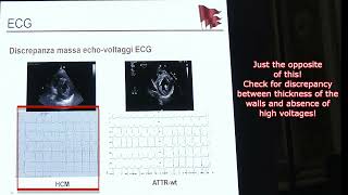 AMILOIDOSI CARDIACA ESSENTIALS OF CARDIAC AMYLOIDOSIS [upl. by Onitsirc]