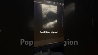 Backer cyst Right popleteal region [upl. by Gabrielle]