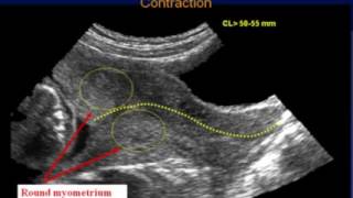 Sonography of the Cervix [upl. by Linad]