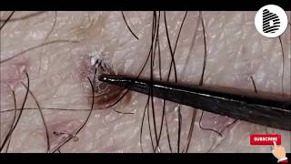 Ingrown Hair Video [upl. by Shipp]