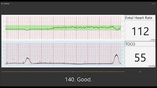 Fetal Heart Monitoring [upl. by Grayce]