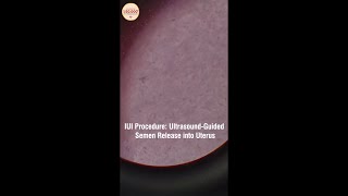 IUI procedure is much simpler than IVF [upl. by Myrilla]