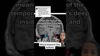 Mesial Temporal Lobe Epilepsy [upl. by Aikem]