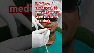 100 percent cured exfoliatve cheilitis treated by Laser and medicines [upl. by Ajup]