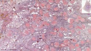 Histopathology  Kidney Amyloidosis [upl. by Boylan]