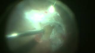 Surgery for Traction Retinal Detachment in Proliferative Diabetic Retinopathy [upl. by Allis36]