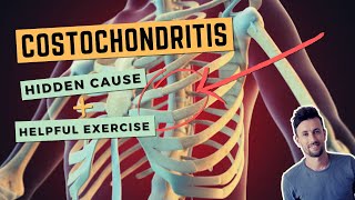 Costochondritis The Hidden Cause and a Simple Exercise to Fix Anterior Rib Joint Pain [upl. by Onairelav617]