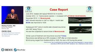 Successful MicroPulse Treatment for Macular Edema in Retinal Vein Occlusion [upl. by Ayamat]